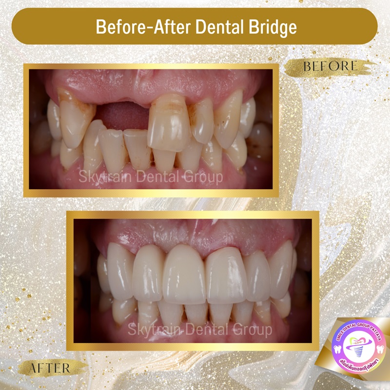 Dental-bridge-en (2) - Central Pattaya Dental Center