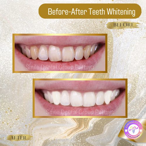 Teeth Whitening Central Pattaya Dental Center